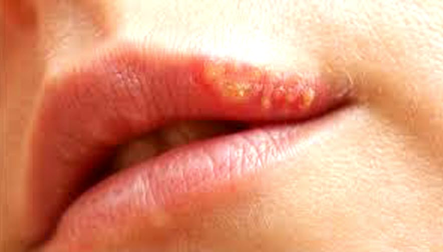 O que é herpes labial e como tratar